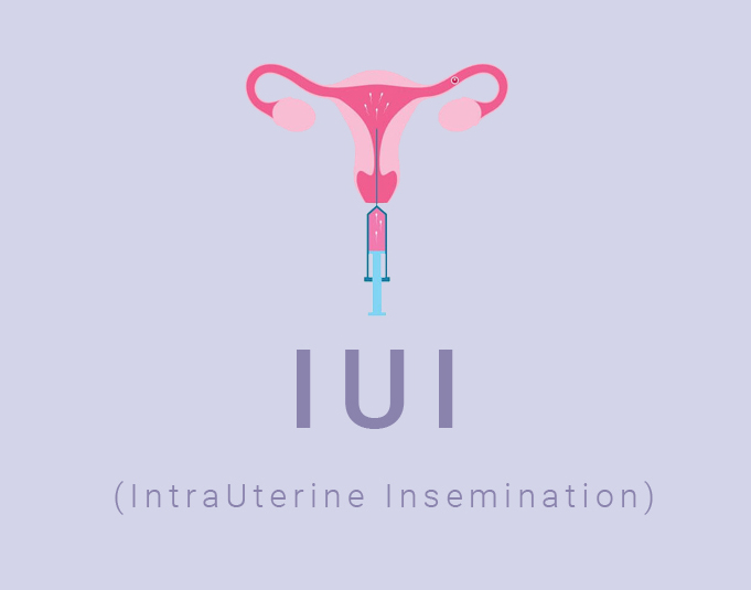 endomitria-spermategxysi